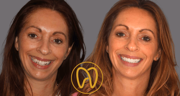 Teeth Straightening at Forever Dental and Skin