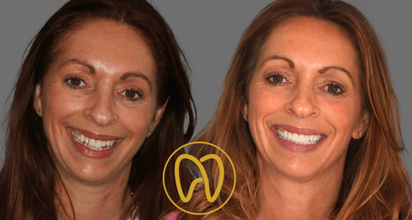 Before and after smile transformation
