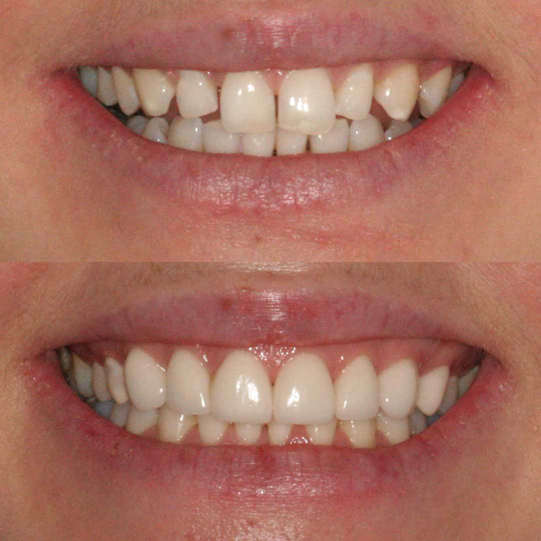 what-you-need-to-know-about-dental-veneers-forever-dental-and-skin
